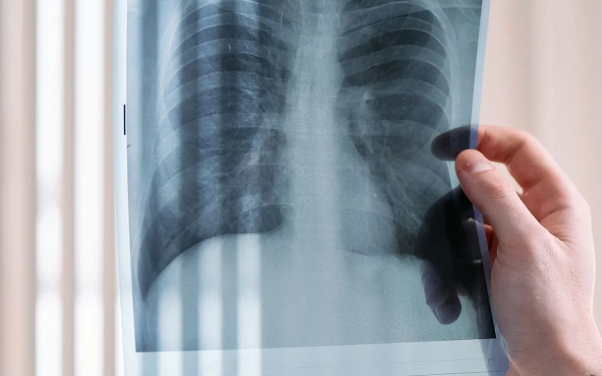 Cadru medical examinând o radiografie a plămânilor