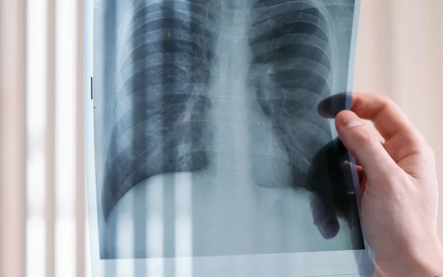 Cadru medical examinând o radiografie a plămânilor